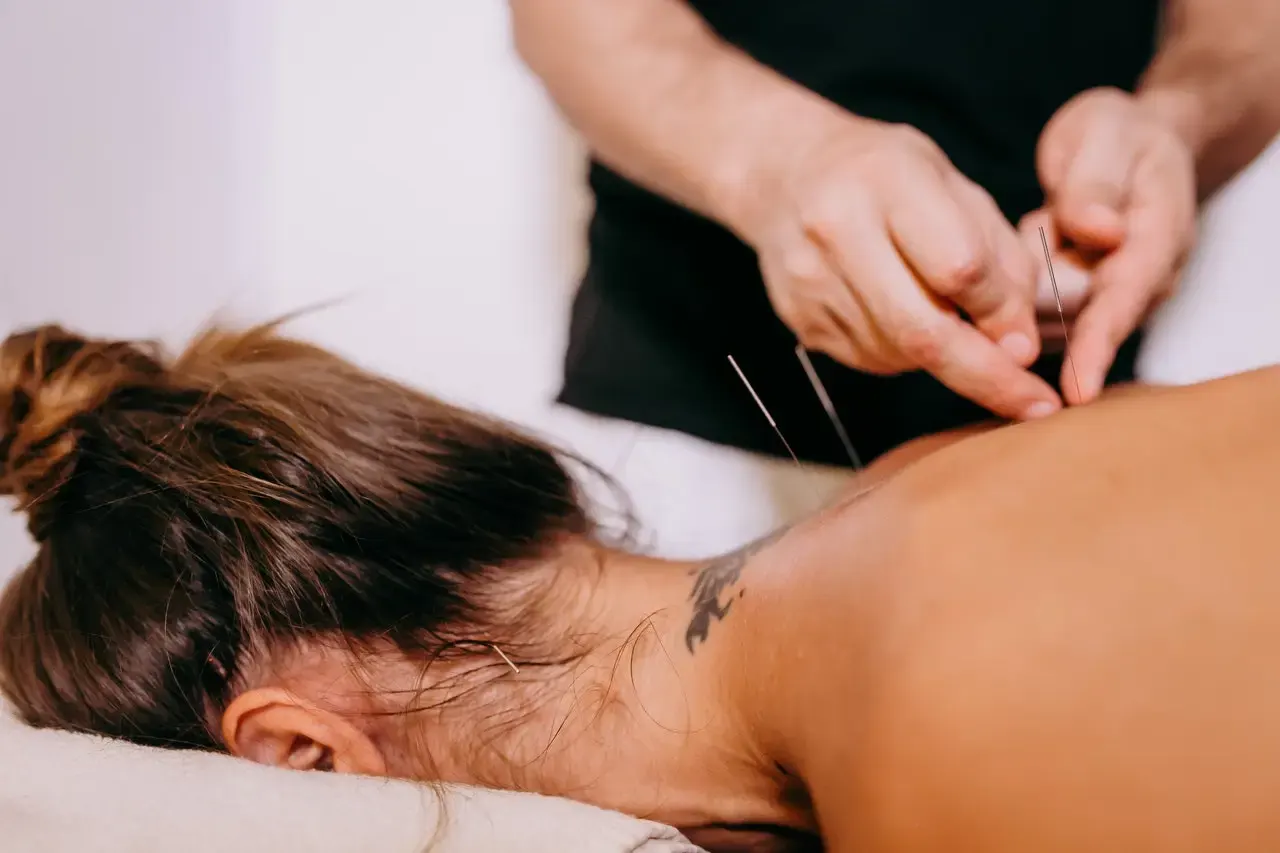 Acupuncture treatment at Acupuncture In NYC, Upper West Side